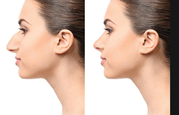 Comment corriger votre nez asymétrique