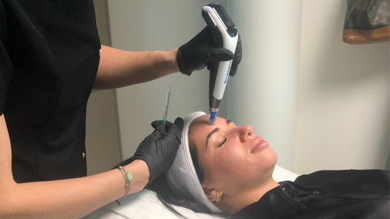 microneedling