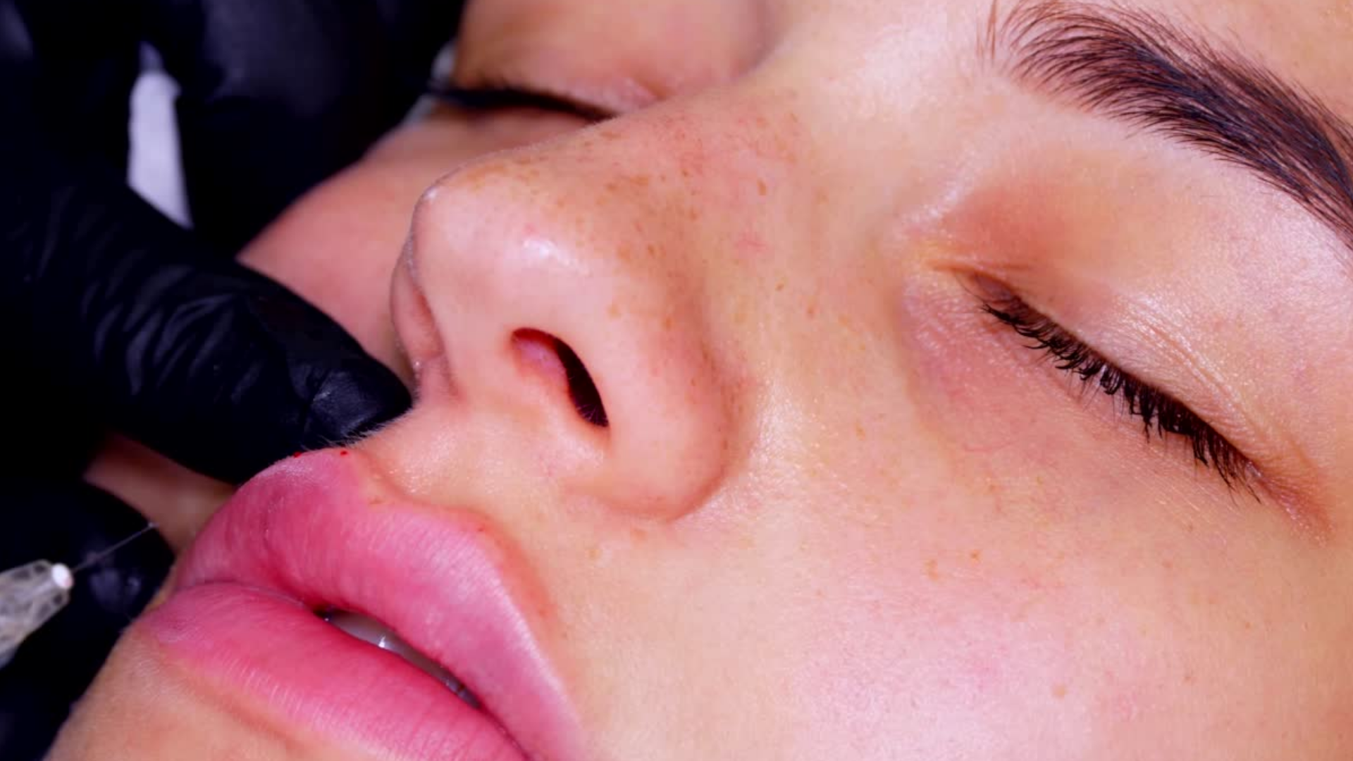 injection acide hyaluronique lausanne